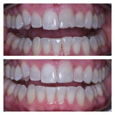 Same day treatment to replace old and broken down fillings and to straighten the front, top teeth.