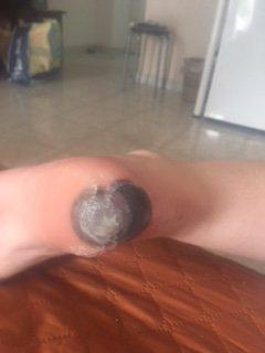 my daughter's heel after the 'treatment of Dr. Hanson. He burned her heel and he said that was medical complication. STAY AWAY!!!!1