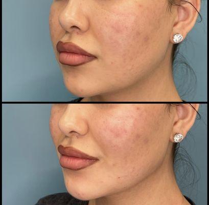 Jawline transformation, using dermal filler at ZO Skin Centre Dallas.