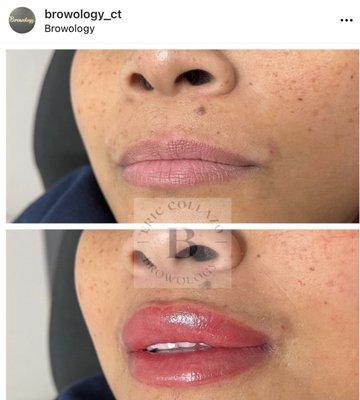 Lip pigmentation lasting 3-4 years