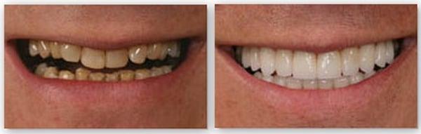 Porcelain Veneers