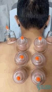 Cupping therapy