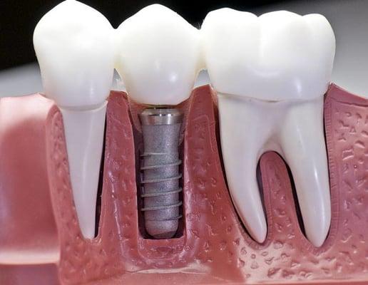 Ask us today how to restore an implant to replace that missing tooth, 201.434.3819.