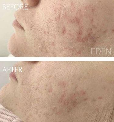 Microneedling with PRP