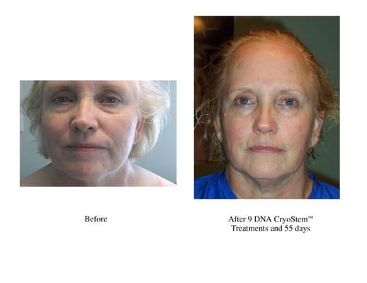 More results from stem cell therapy!