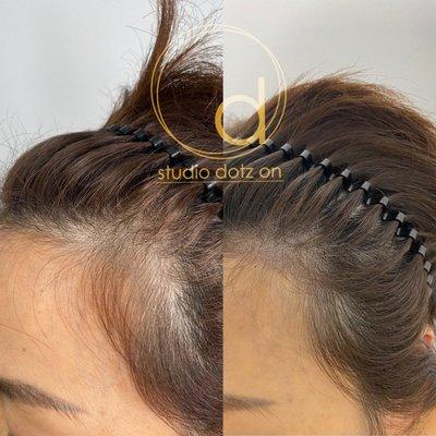 Hair Density by adding dots tattooing(scalp micro pigmentation) to give a fuller hair look