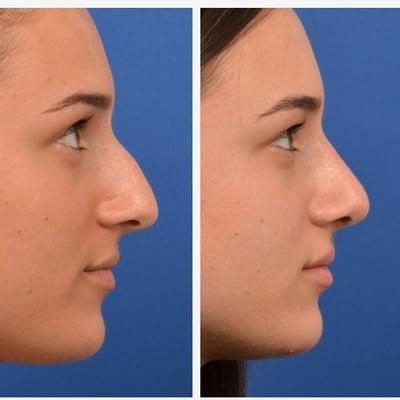 Rhinoplasty