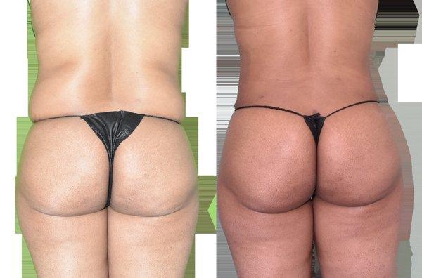 Liposuction with fat transfer to the butt.