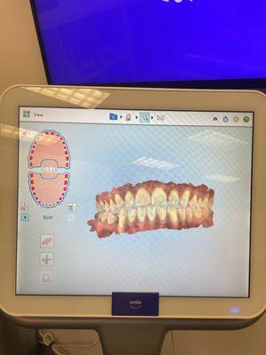 They do a 3D print of you teeth