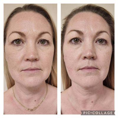 Who needs a time machine when you have a non-invasive facelift? Turn back the clock with V-ST Skin Tightening Treatment!