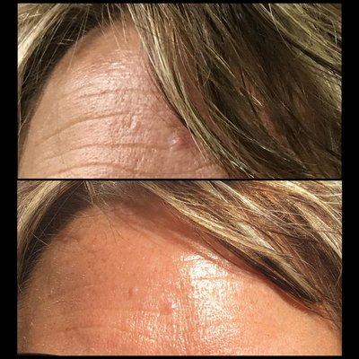 Before & After: 4 treatments of the Signature Nano-facial