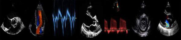 Echocardiogram