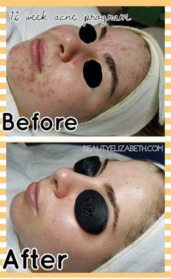 Clear your acne... no prescriptions, private & educational.