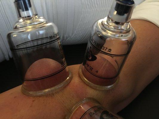 Cupping for tendonosis. Great for blood flow!