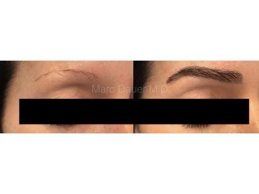 Right brow transplant before and after, performed by Dr. Dauer