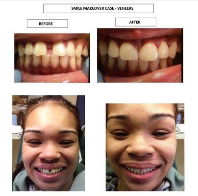 Transformed smile, patient complains about Gap in teeth and lack of confidence due to a terrible smile.