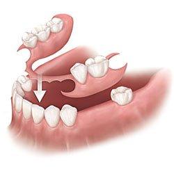 Custom Dentures