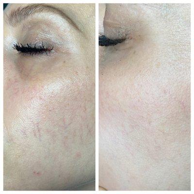 ExcelV Laser to treat facial vessels