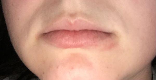 Right side of bottom lip and top of upper lip swollen and itchy