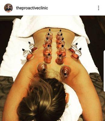 We offer cupping to promote blood circulation and loosen up muscles.