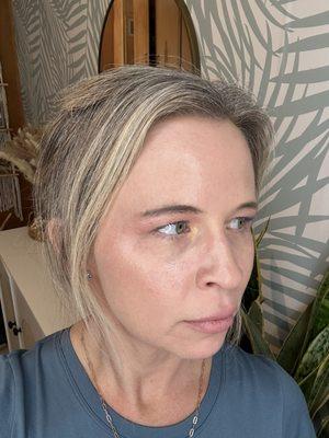 Botox forehead and Botox on side eye lift