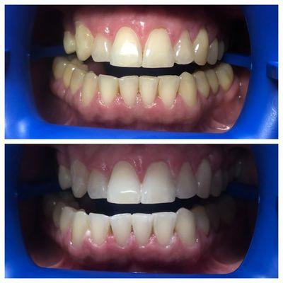 Before & After Zoom Treatment