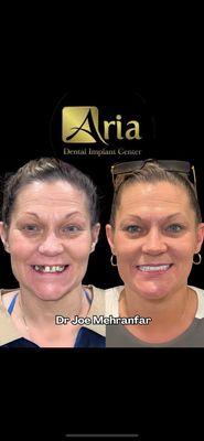 A beautiful before and after with one of our wonderful All on 4® patients.