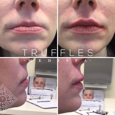 Juvederm Ultra Plus before and after