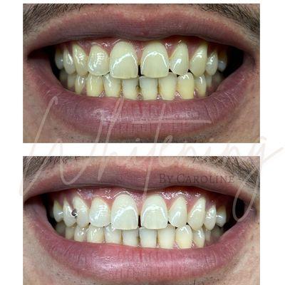 90 min teeth whitening session with a Swarovski tooth gem