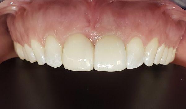 Cosmetic veneers and crowns to match existing teeth!