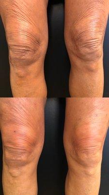 Knee Lift with Bio-Filler