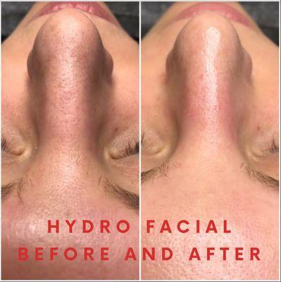 Before and after Hydro Facial