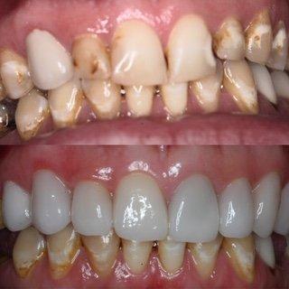 Before and After Porcelain Crowns