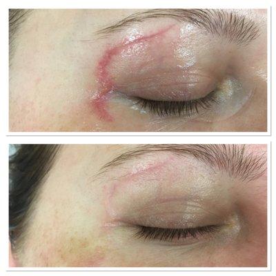 Before any treatment on top; and After MICRO NEEDLING and STEM cells+LED light treatments on the bottom.