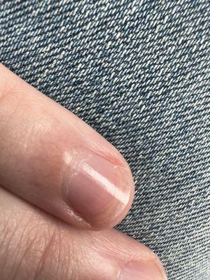 Jagged nail, cuticle not removed