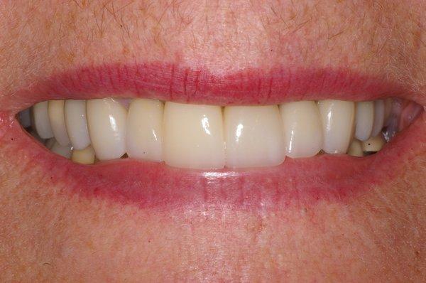 Restored anterior implant