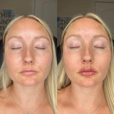 Lip Filler Injections!  Work by Erika at Peace Love Med Spa in Boca Raton, FL!