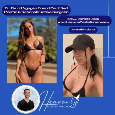 Breast Augmentations By Dr. Nguyen!