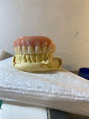 4 locator retained implant denture