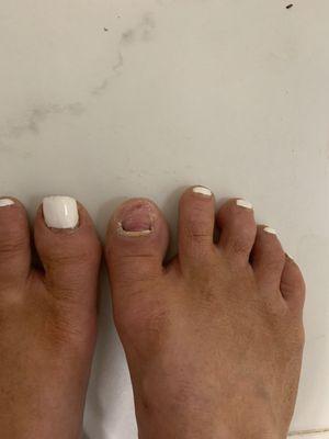 Toenail gone