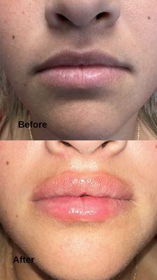 Before and after fillers