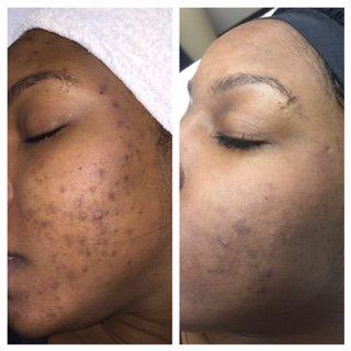 Acne scar removal after 2 treatments!