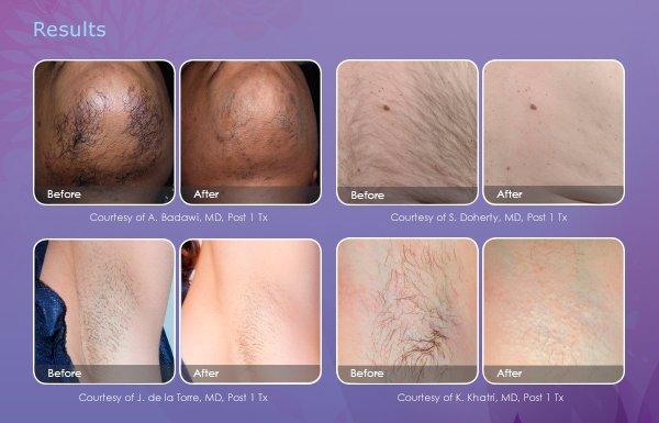 Laser Hair Removal helps remove that unwanted hair & constant shaving/waxing.