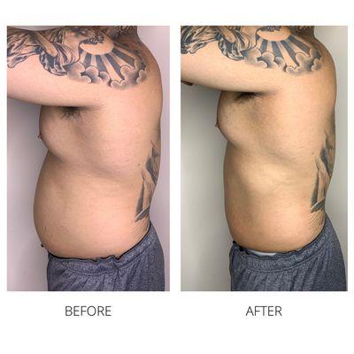 Body Sculpting results after one treatment