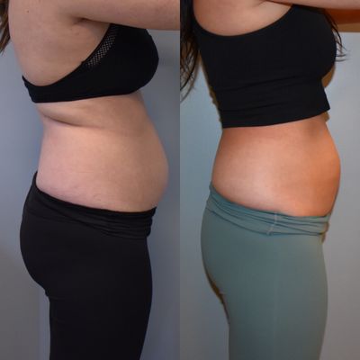 CoolSculpting before & after