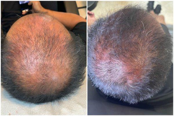 Before/After PRP Hair Restoration