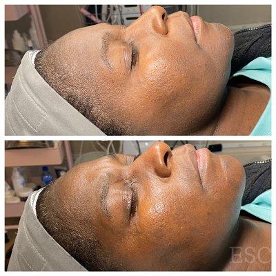 Microdermabrasion for dry skin