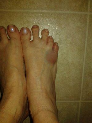 Bruised foot from warn out joints due to bad tracks and rollers on doors in second bedroom.