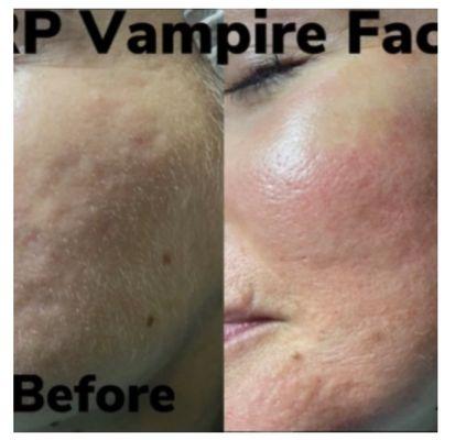 PRP Microneedling to help with acne scars