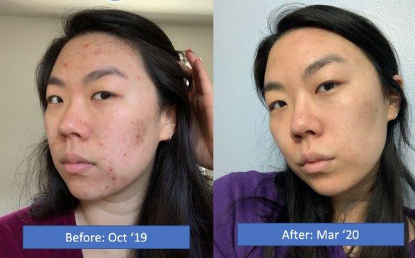 Skin before and after treatments at Meridiem Esthetics